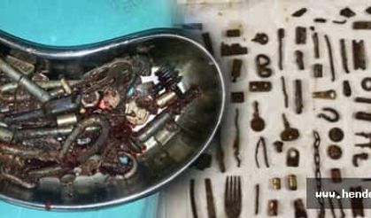 Midesinden Kesici Aletler Çıktı!